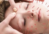 Cosmetische Acupunctuur